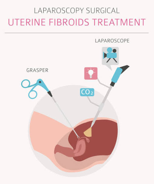 Best Uterine Fibroids Treatment Surgeon in Borivali